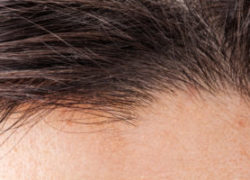 Treat Your Scalp Disorder Symptoms and Hair Thinning in Carrollton, TX