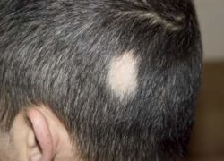 Recognizing Alopecia Areata and How To Treat It