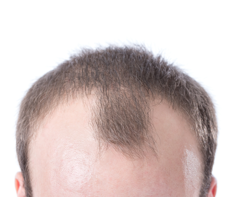 What to use for receding hairline