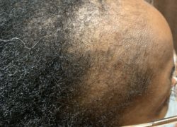 Understanding Traction Alopecia and Its Causes