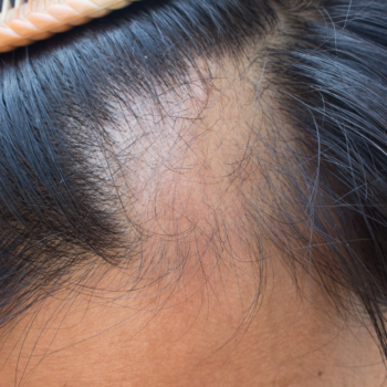 Thinning and receding hairline on Male