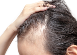 Unraveling Alopecia: Risks and Causes of Hair Loss