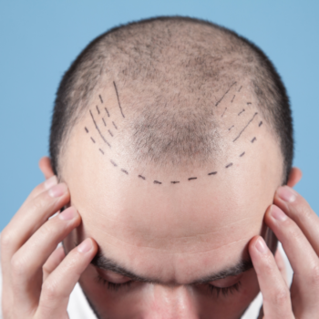 Man with scalp marked for hair transplant