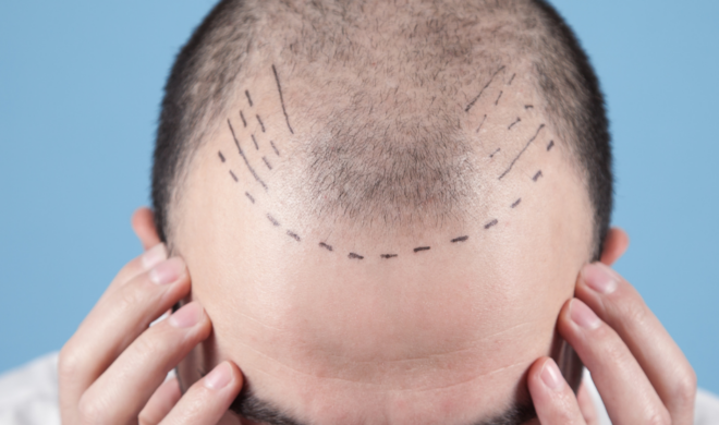 Man with scalp marked for hair transplant
