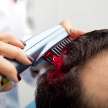 Man receiving Laser Therapy for hair loss