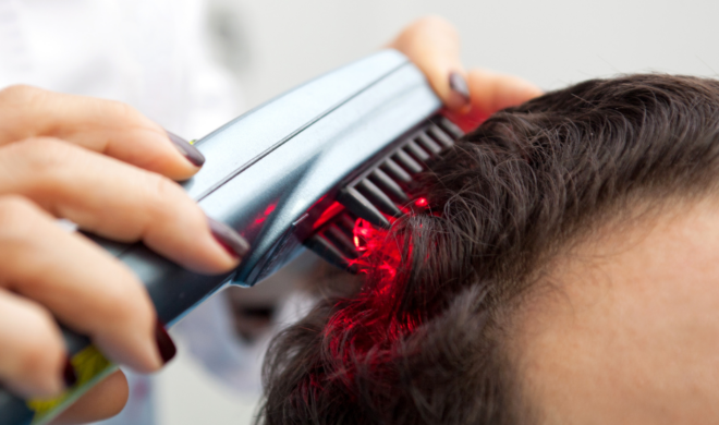 Man receiving Laser Therapy for hair loss