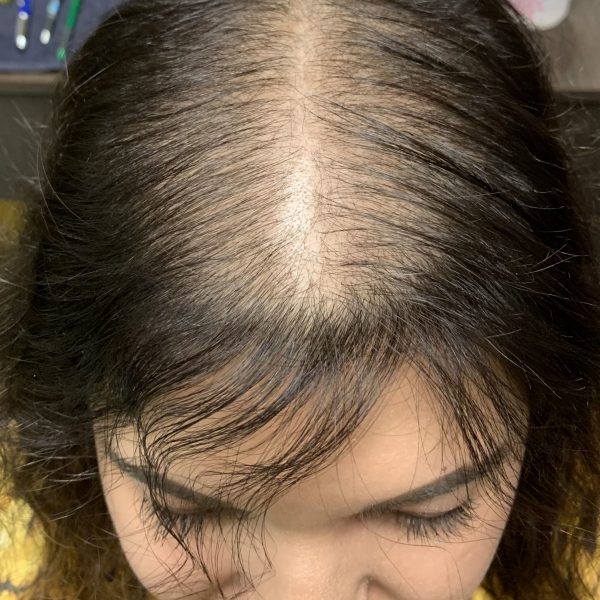 androgenetic-alopecia-1-after