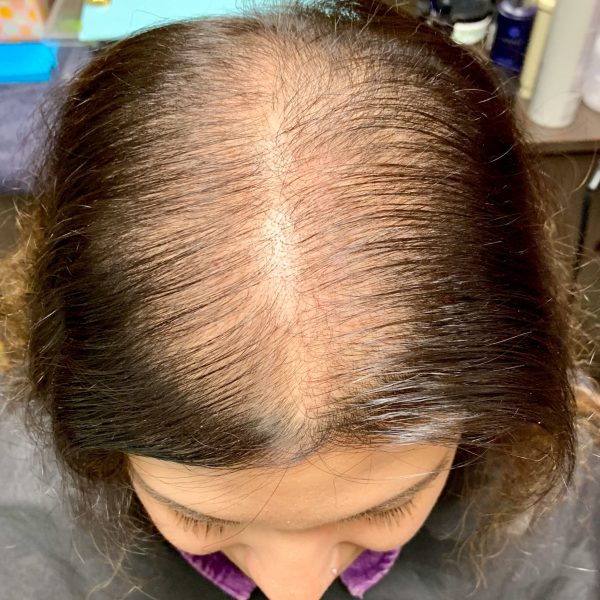 androgenetic-alopecia-1-before