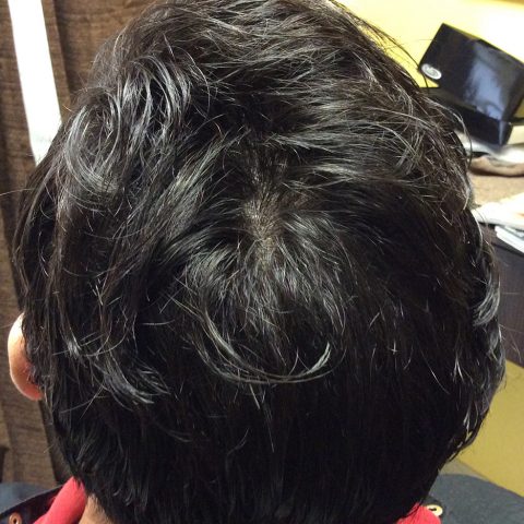 Non-Surgical Hair Replacement - After