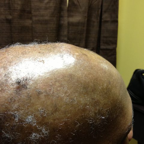 Non-Surgical Hair Replacement - Before